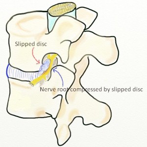 Lower Back Pain | Sciatica Treatment In Singapore - Pan Orthopaedics ...